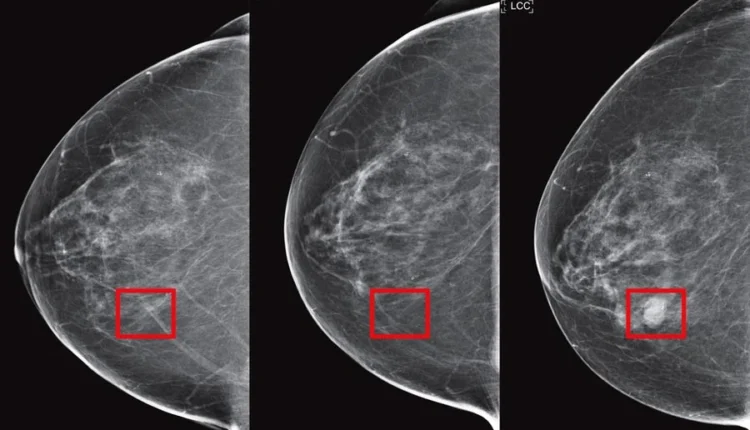 Mirai Une IA pour la Détection Précoce du Cancer du Sein - TAG